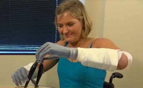 Aimee Copeland Gets New Bionic Hands